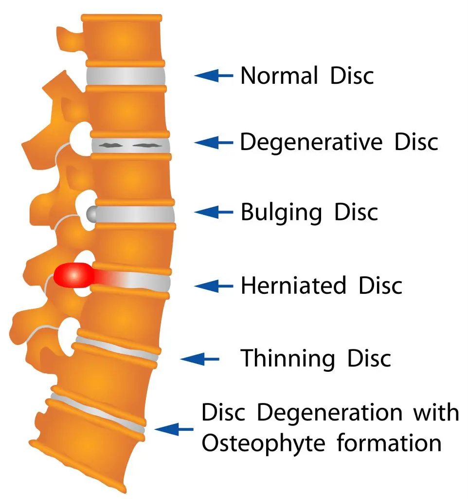 Disc Degeneration Fort Wayne Chart 