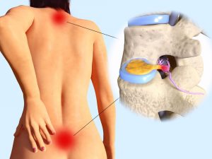 3d image of a woman's back with herniated discs