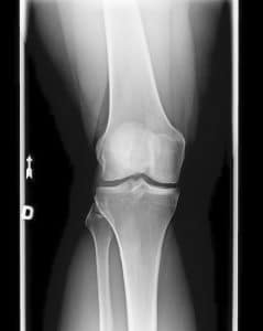 x-ray of a patients knee