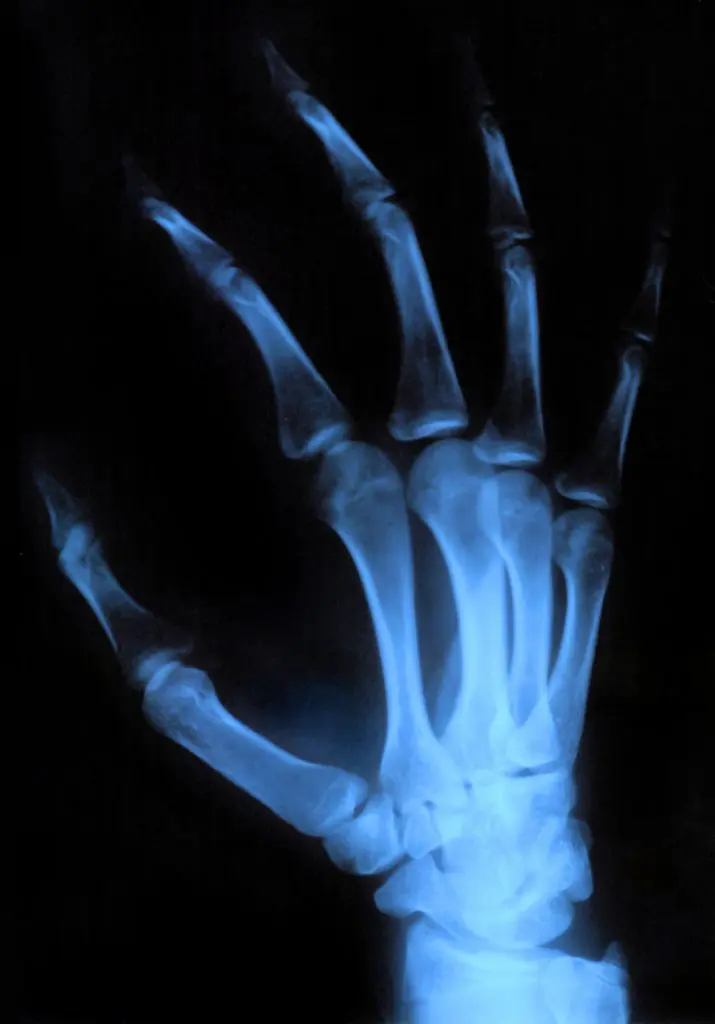 x-ray image of a hand