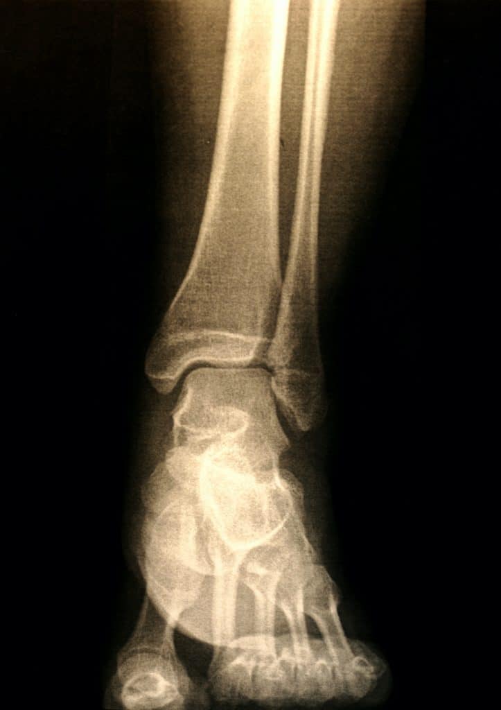 x-ray image of an ankle 