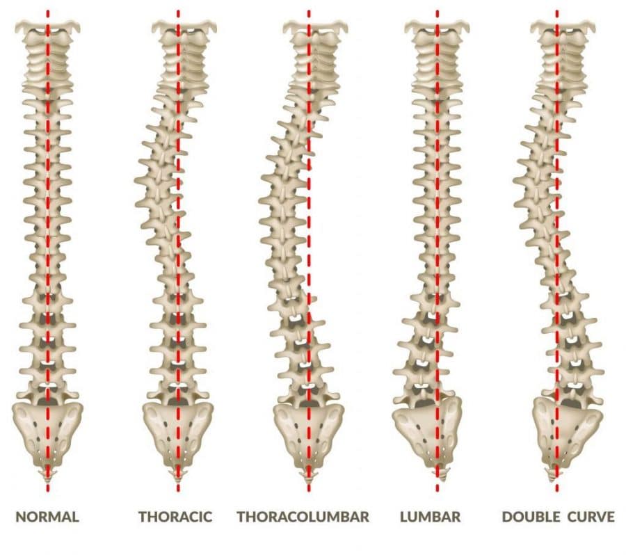 diagram of the different types of scoliosis 