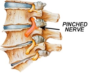 Pinched Nerve Representation
