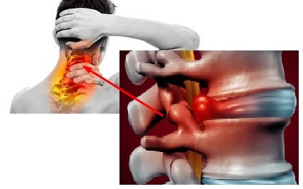 Pinched Nerve on neck