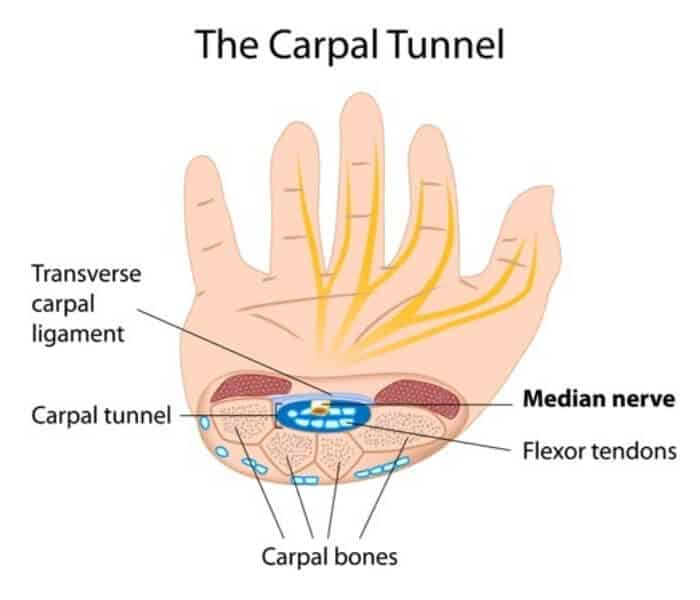 Medical illustration of carpal tunnel syndrome