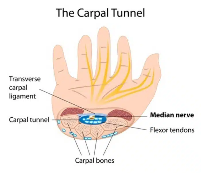 Medical illustration of carpal tunnel syndrome 